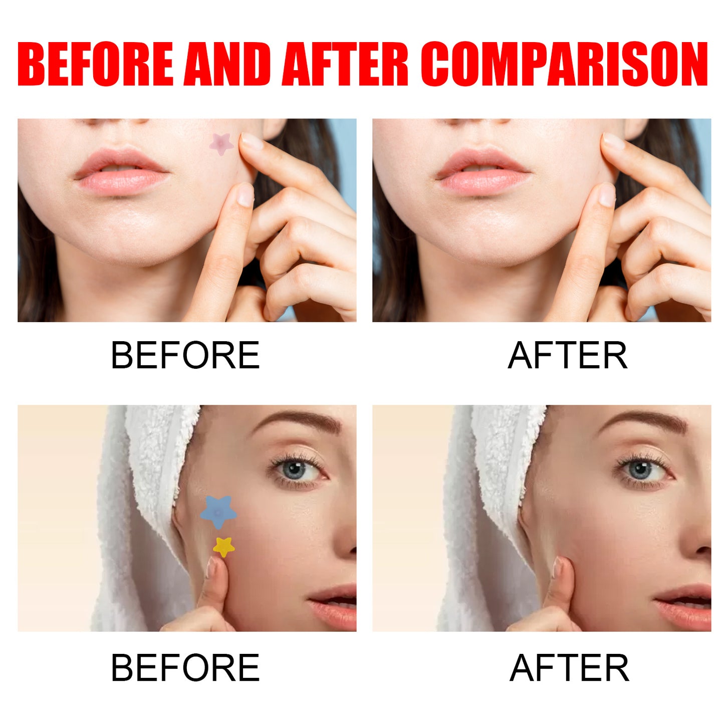 Star Pimple Patches for covering zits and blemishes